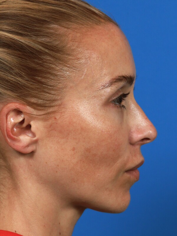 CO2 Laser Resurfacing Before & After Image