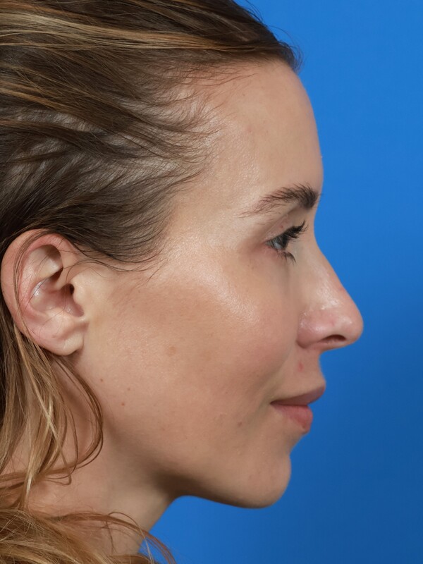 CO2 Laser Resurfacing Before & After Image