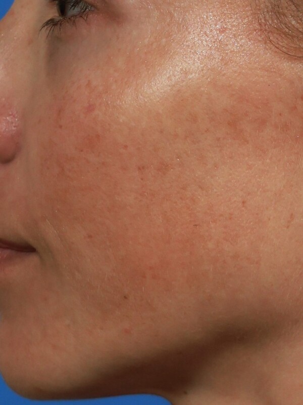 CO2 Laser Resurfacing Before & After Image
