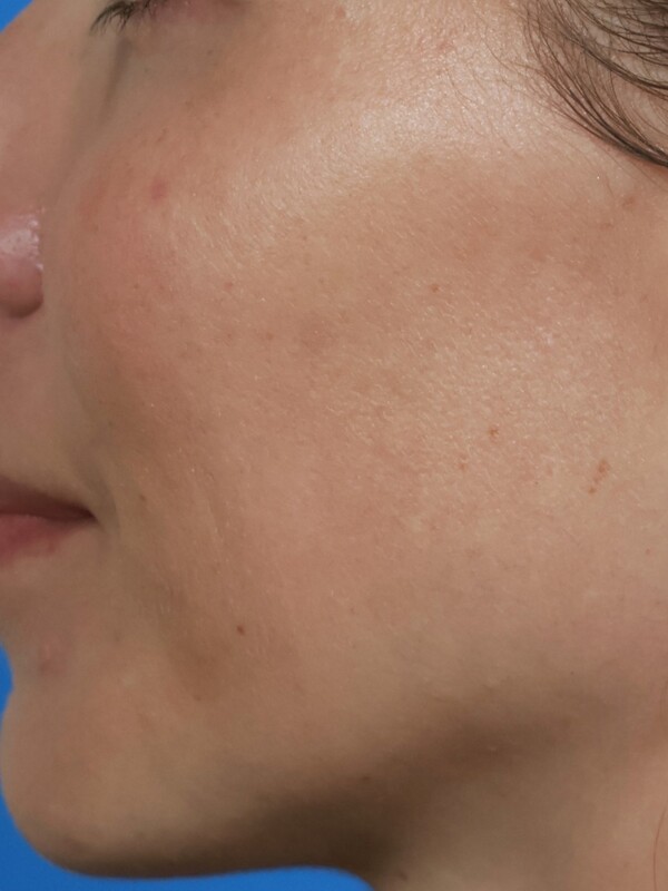 CO2 Laser Resurfacing Before & After Image