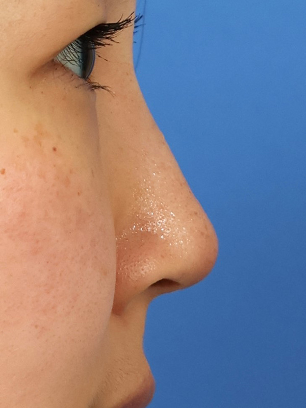 Liquid Rhinoplasty Before & After Image