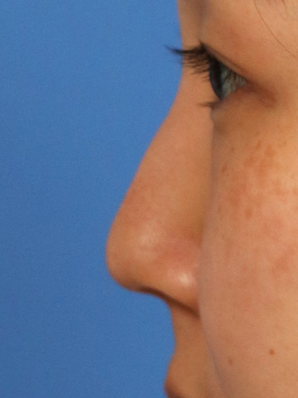 Liquid Rhinoplasty Before & After Image