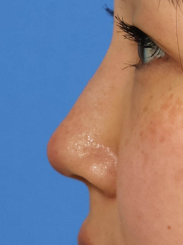 Liquid Rhinoplasty Before & After Image