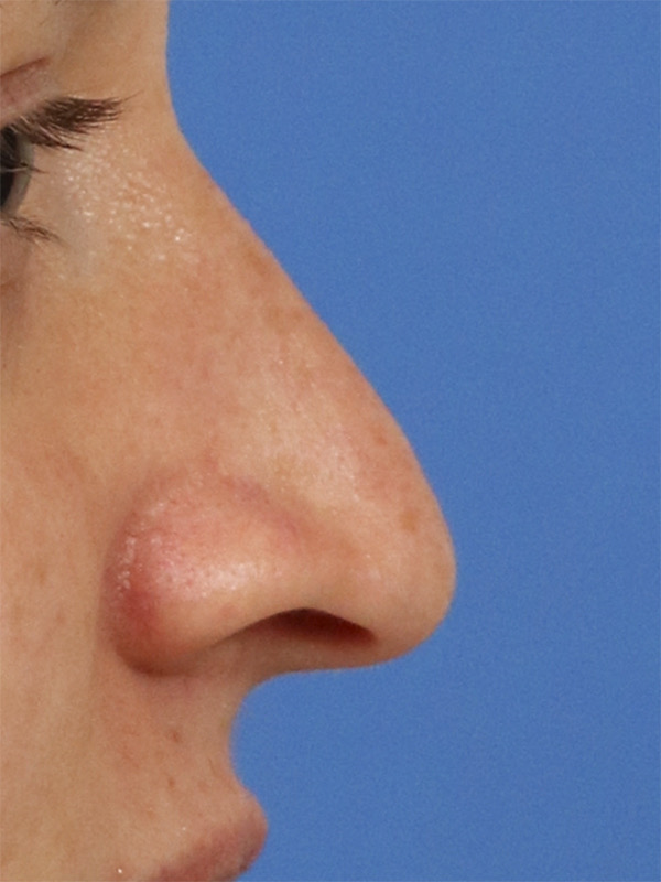 Liquid Rhinoplasty Before & After Image