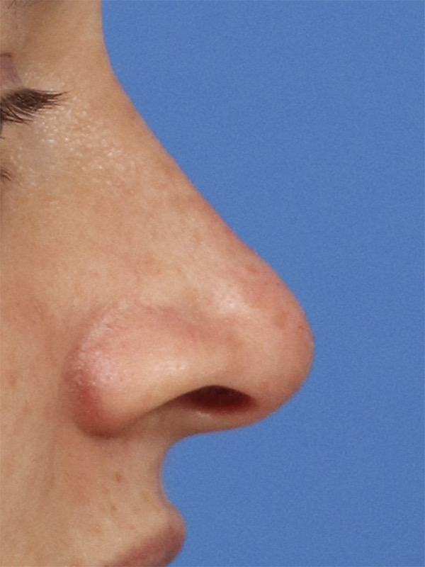 Liquid Rhinoplasty Before & After Image