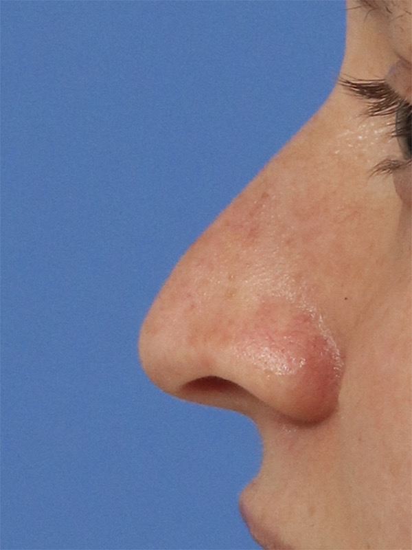 Liquid Rhinoplasty Before & After Image