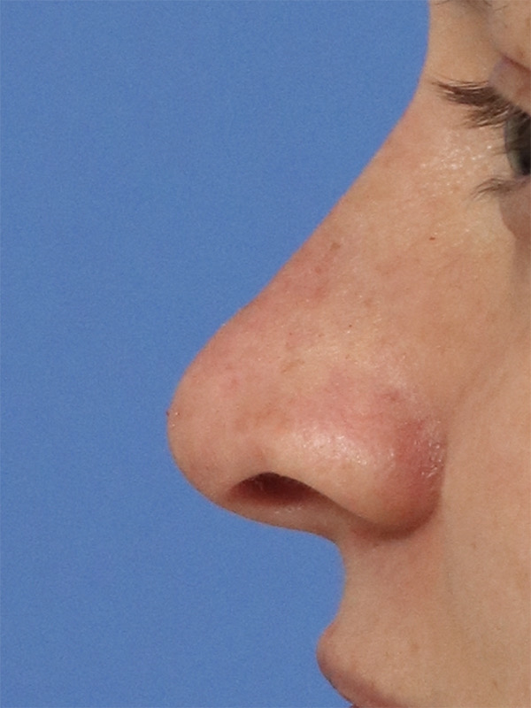 Liquid Rhinoplasty Before & After Image