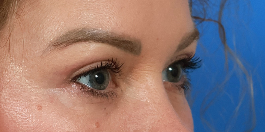 Blepharoplasty Before & After Image