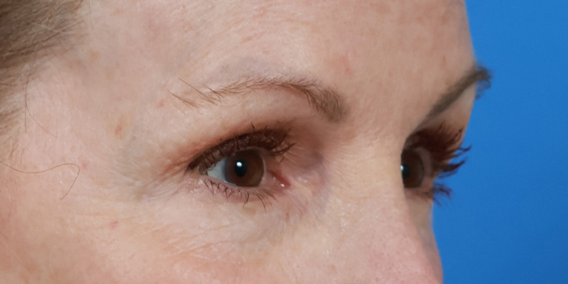 Blepharoplasty Before & After Image