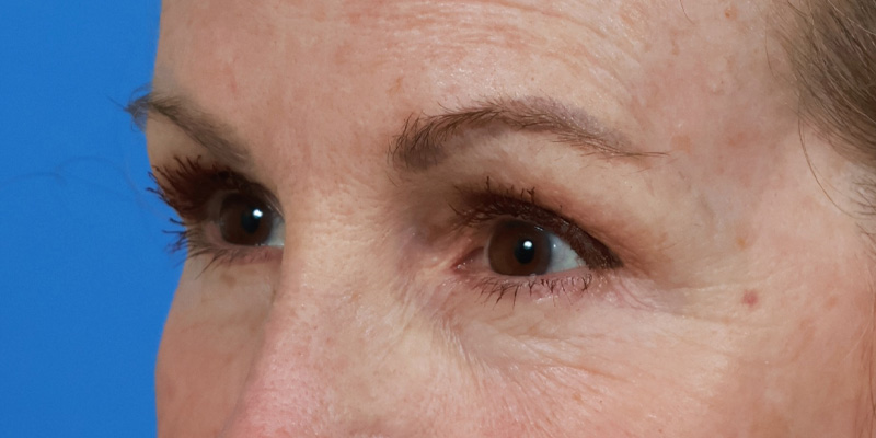Blepharoplasty Before & After Image