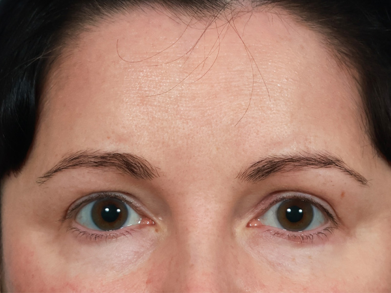 Brow Lift Before & After Image