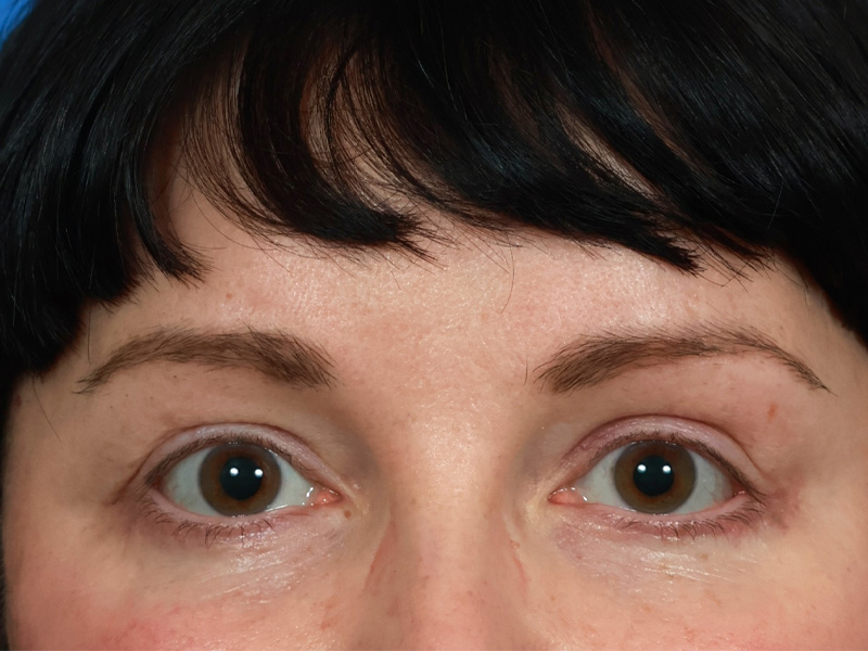 Brow Lift Before & After Image