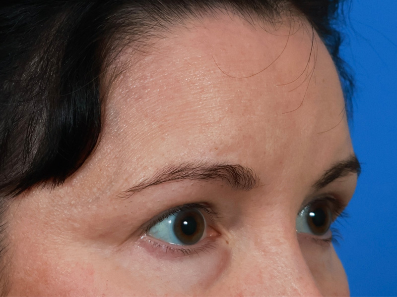 Brow Lift Before & After Image