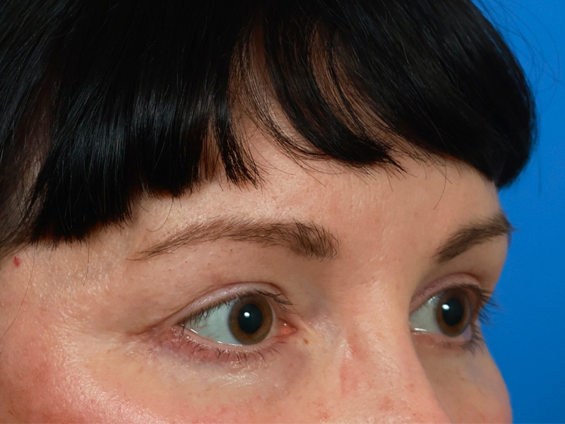 Brow Lift Before & After Image