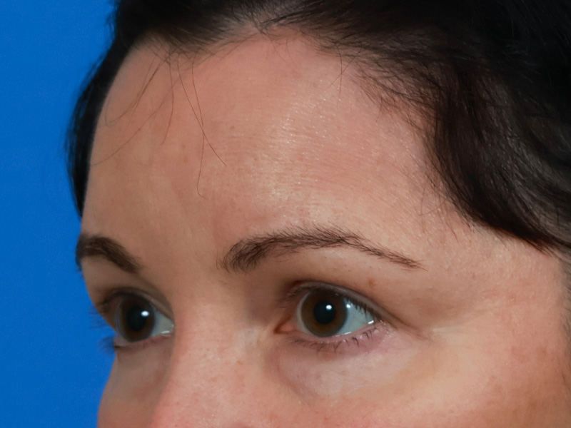 Brow Lift Before & After Image