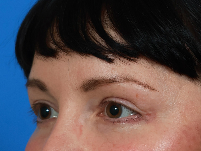 Brow Lift Before & After Image