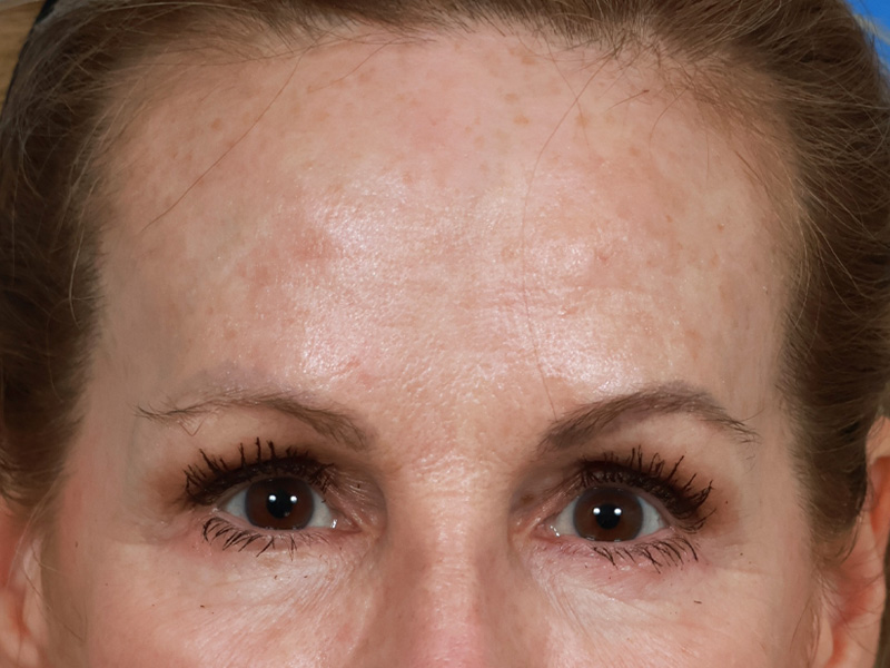 Brow Lift Before & After Image