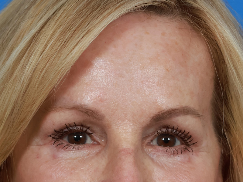 Brow Lift Before & After Image