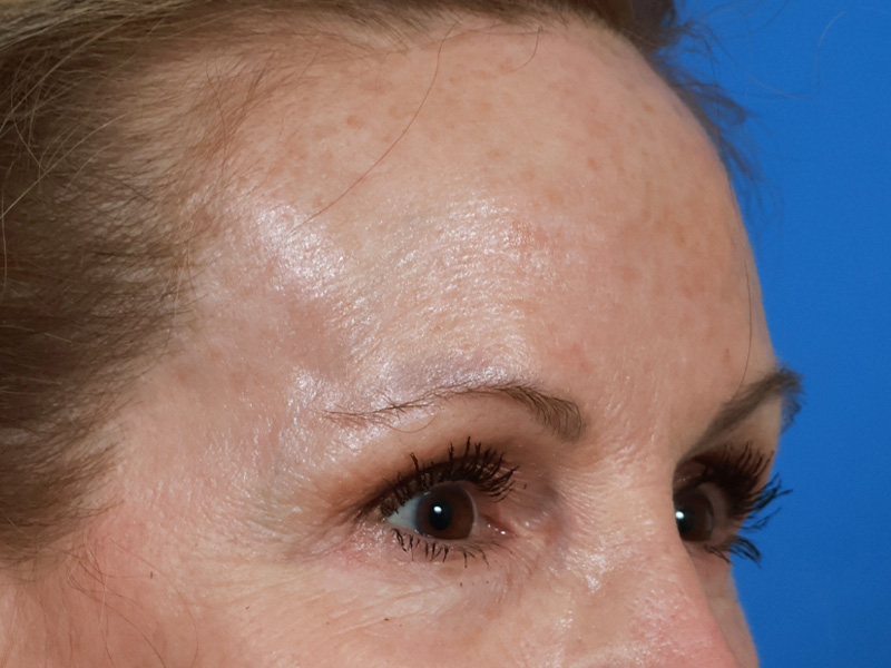 Brow Lift Before & After Image