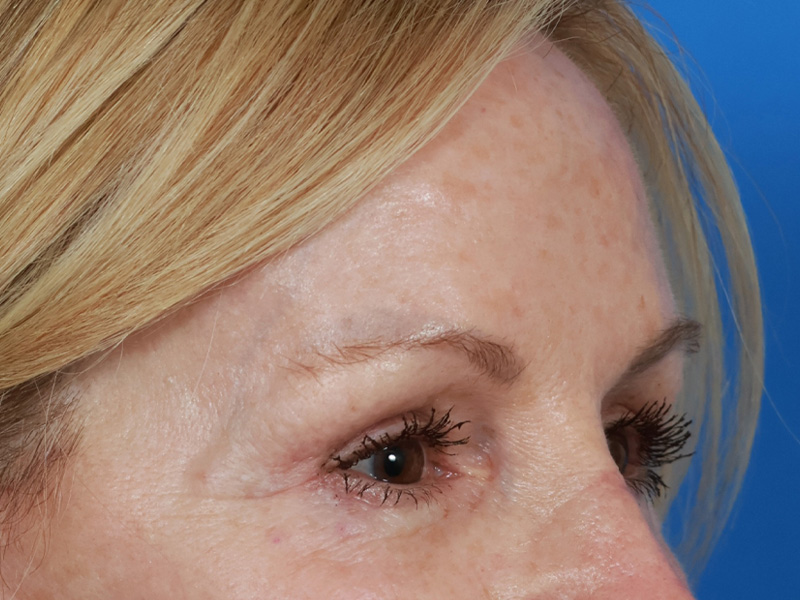 Brow Lift Before & After Image