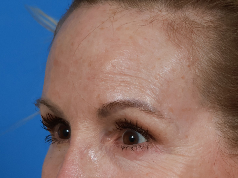 Brow Lift Before & After Image