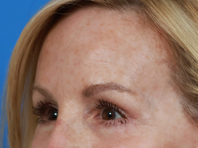 Brow Lift Before & After Image