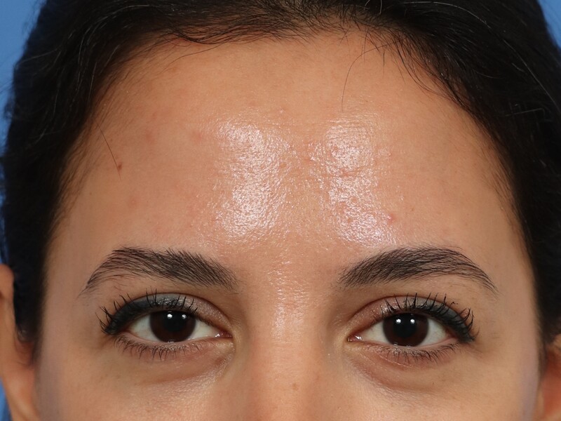 Brow Lift Before & After Image