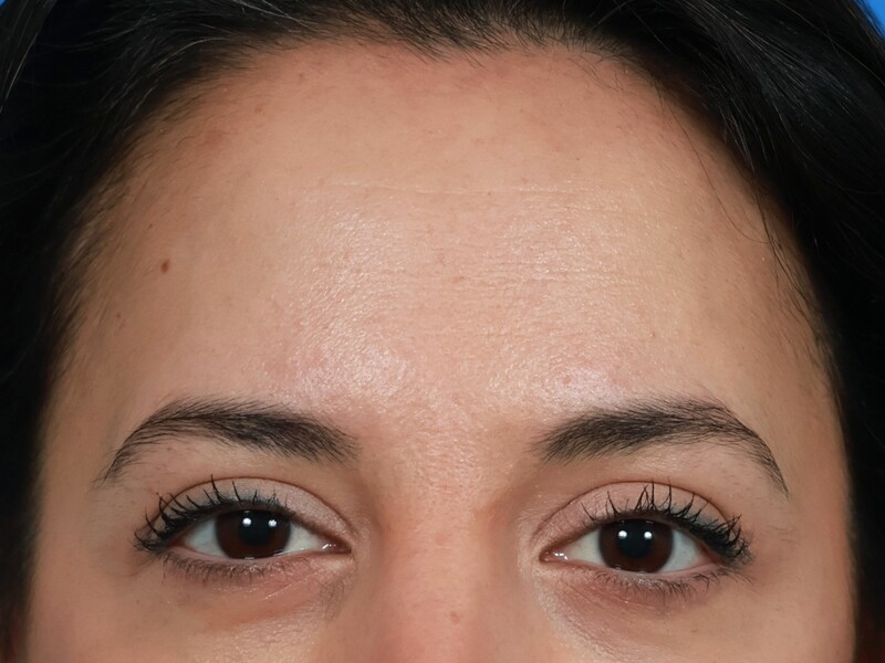 Brow Lift Before & After Image