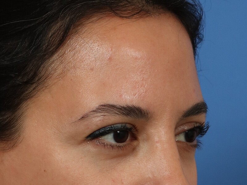 Brow Lift Before & After Image