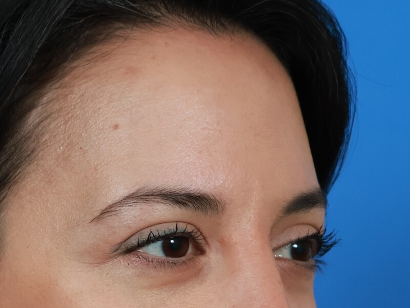Brow Lift Before & After Image