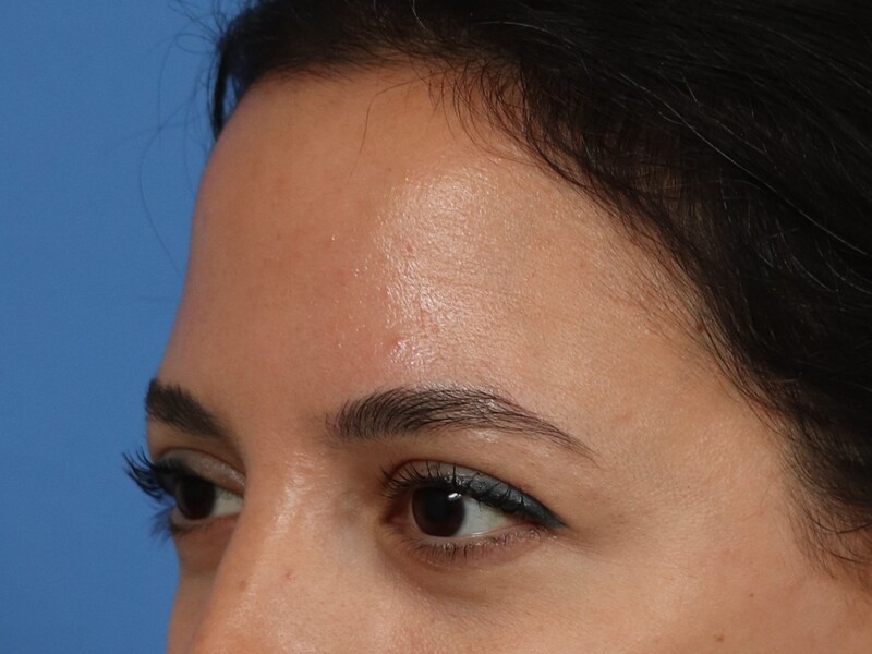 Brow Lift Before & After Image
