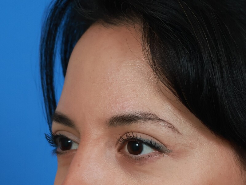 Brow Lift Before & After Image