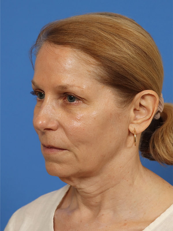 Deep Plane Facelift Before & After Image