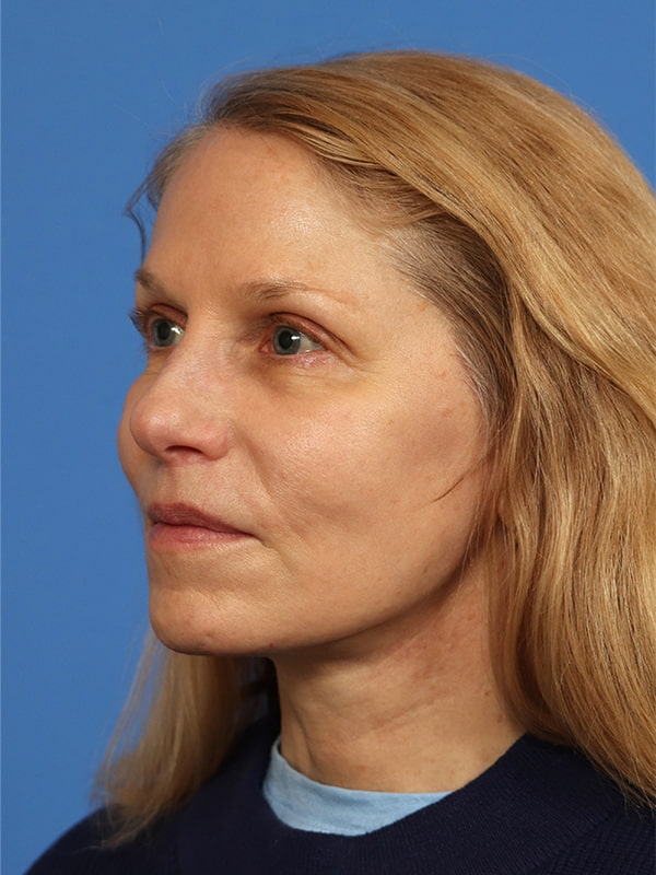Deep Plane Facelift Before & After Image