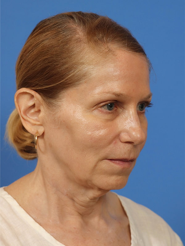 Deep Plane Facelift Before & After Image