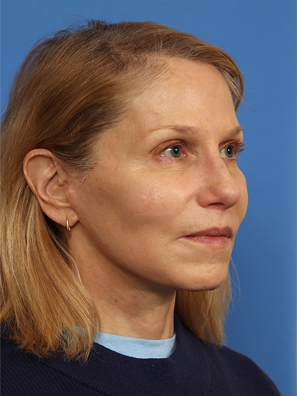Deep Plane Facelift Before & After Image