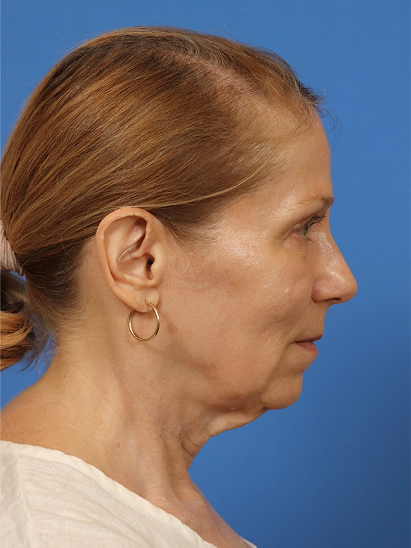 Deep Plane Facelift Before & After Image