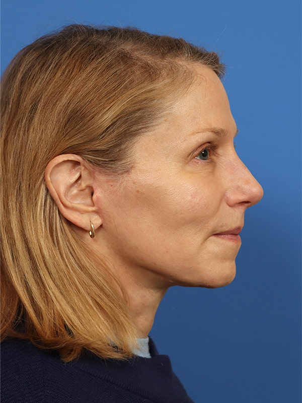 Deep Plane Facelift Before & After Image