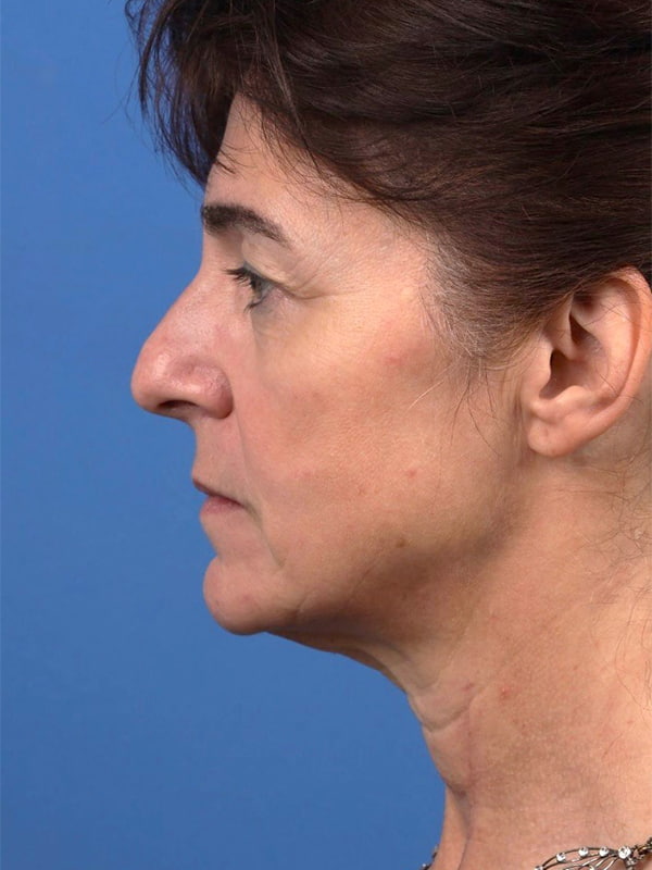 Deep Plane Facelift Before & After Image