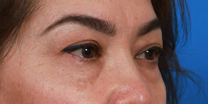Eyelid Lift Before & After Image