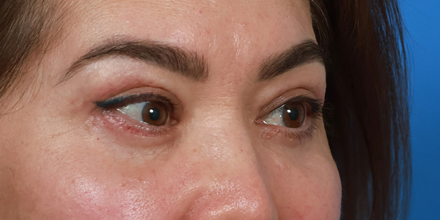Eyelid Lift Before & After Image