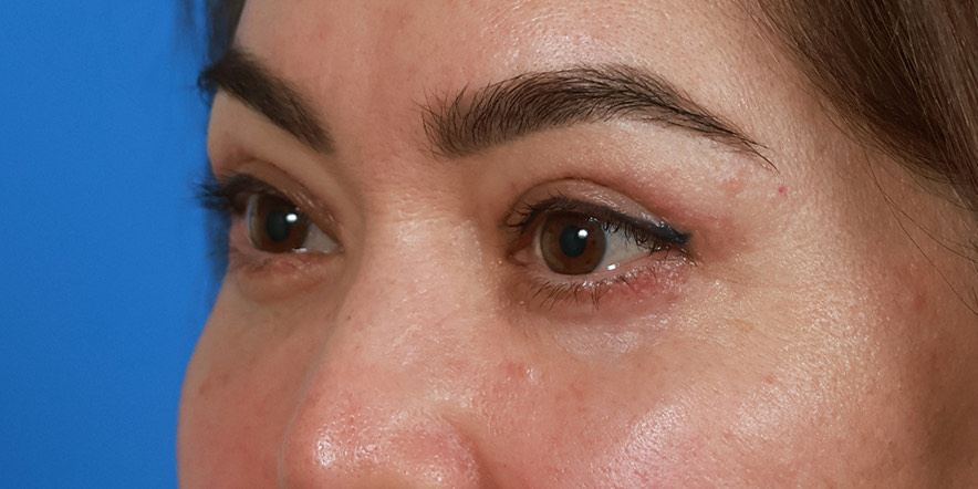 Eyelid Lift Before & After Image