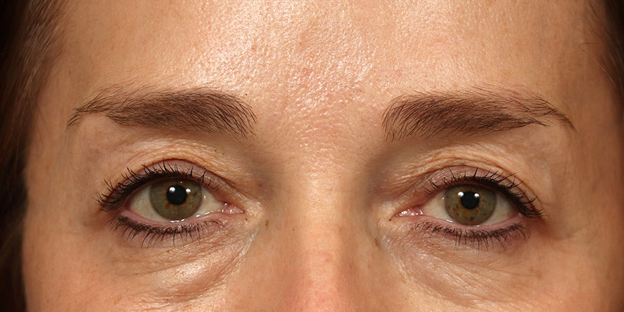 Eyelid Lift Before & After Image