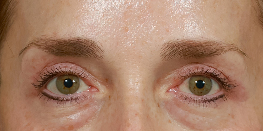 Eyelid Lift Before & After Image