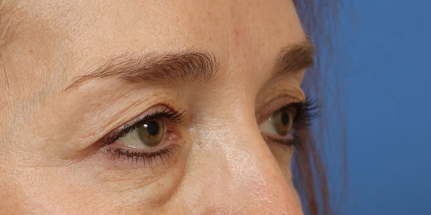 Eyelid Lift Before & After Image