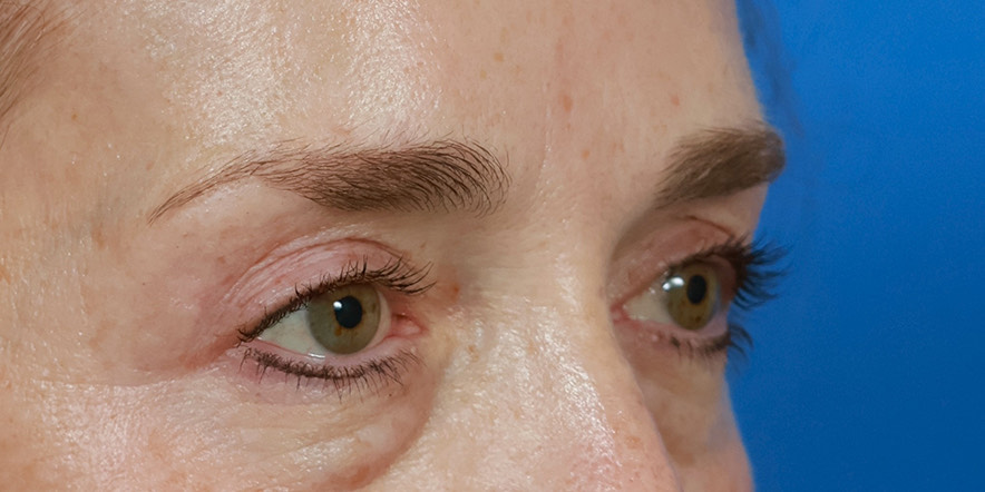 Eyelid Lift Before & After Image