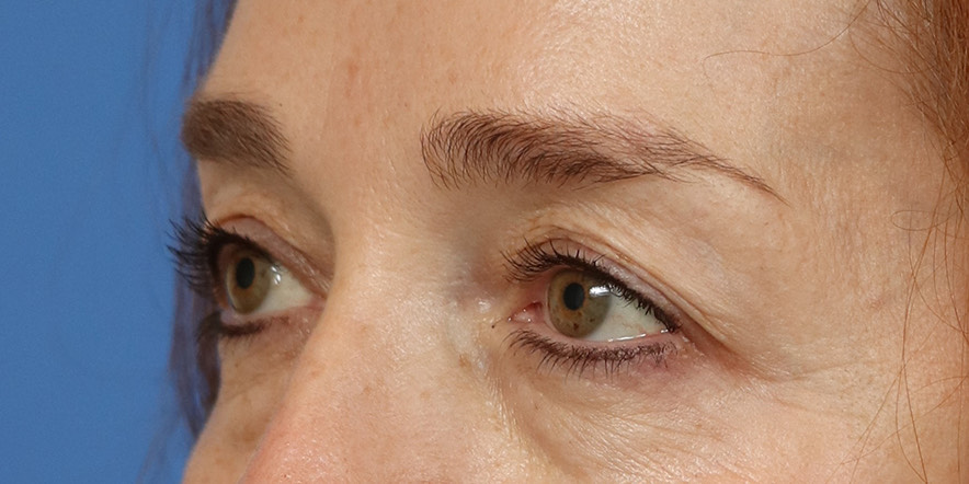 Eyelid Lift Before & After Image