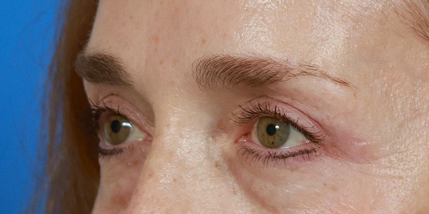 Eyelid Lift Before & After Image