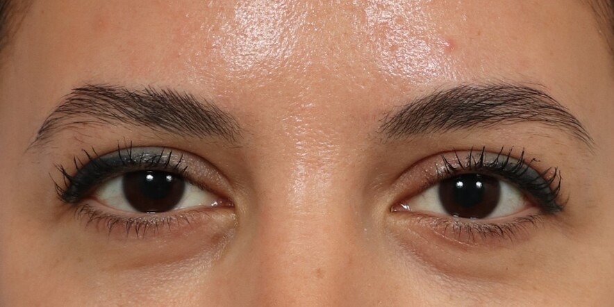Eyelid Lift Before & After Image