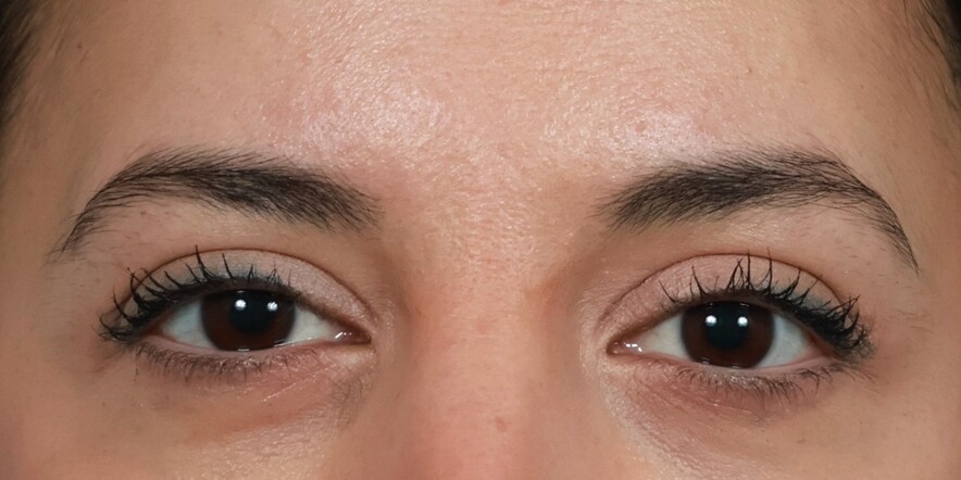Eyelid Lift Before & After Image